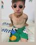 8 yaşında oğlan Xeste 40 günlükken başlayan infeksiyon ...