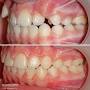 Dr. Elchin Gaziyev Orthodontist | 🇦🇿 Heç bir diş çəkilmədən ...