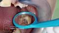 5 kanallı molyar diş #stomatoloqperviz - YouTube