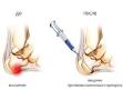 Блокады в травматологии и ортопедии | Показания, польза и вред