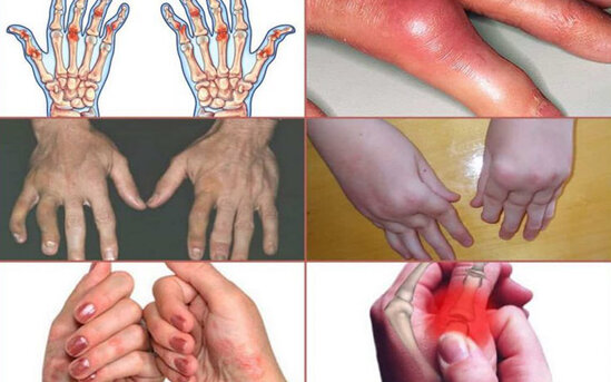 Psoriatik artrit. Simptomlar, diaqnostika, mualice