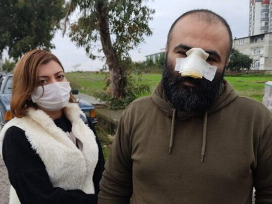 Pitbul azerbaycanli ish adaminin burnunu qopardi